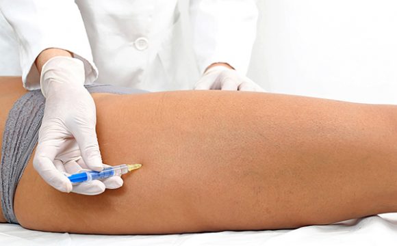 Mesoterapia